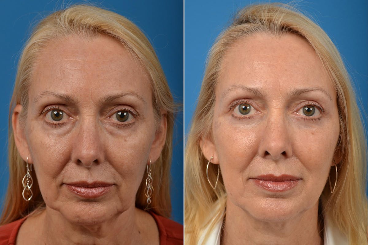 Eyelid Surgery Before & After Gallery - Patient 122444679 - Image 1