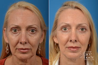 Eyelid Surgery Before & After Gallery - Patient 397326 - Image 1