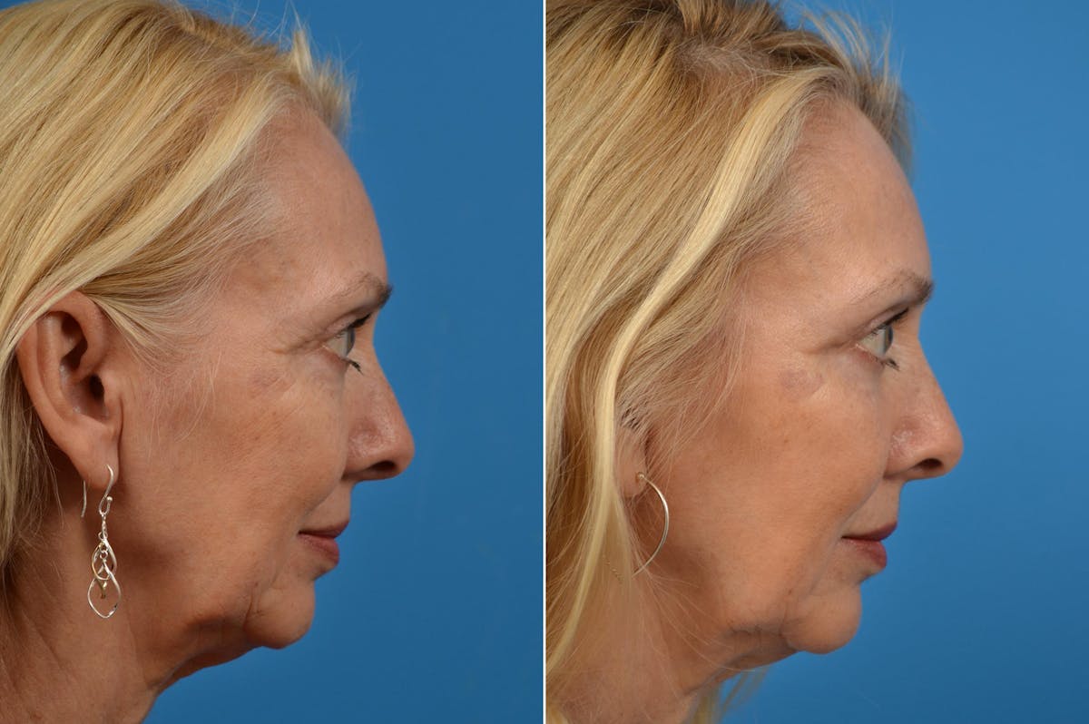 Eyelid Surgery Before & After Gallery - Patient 122444679 - Image 2