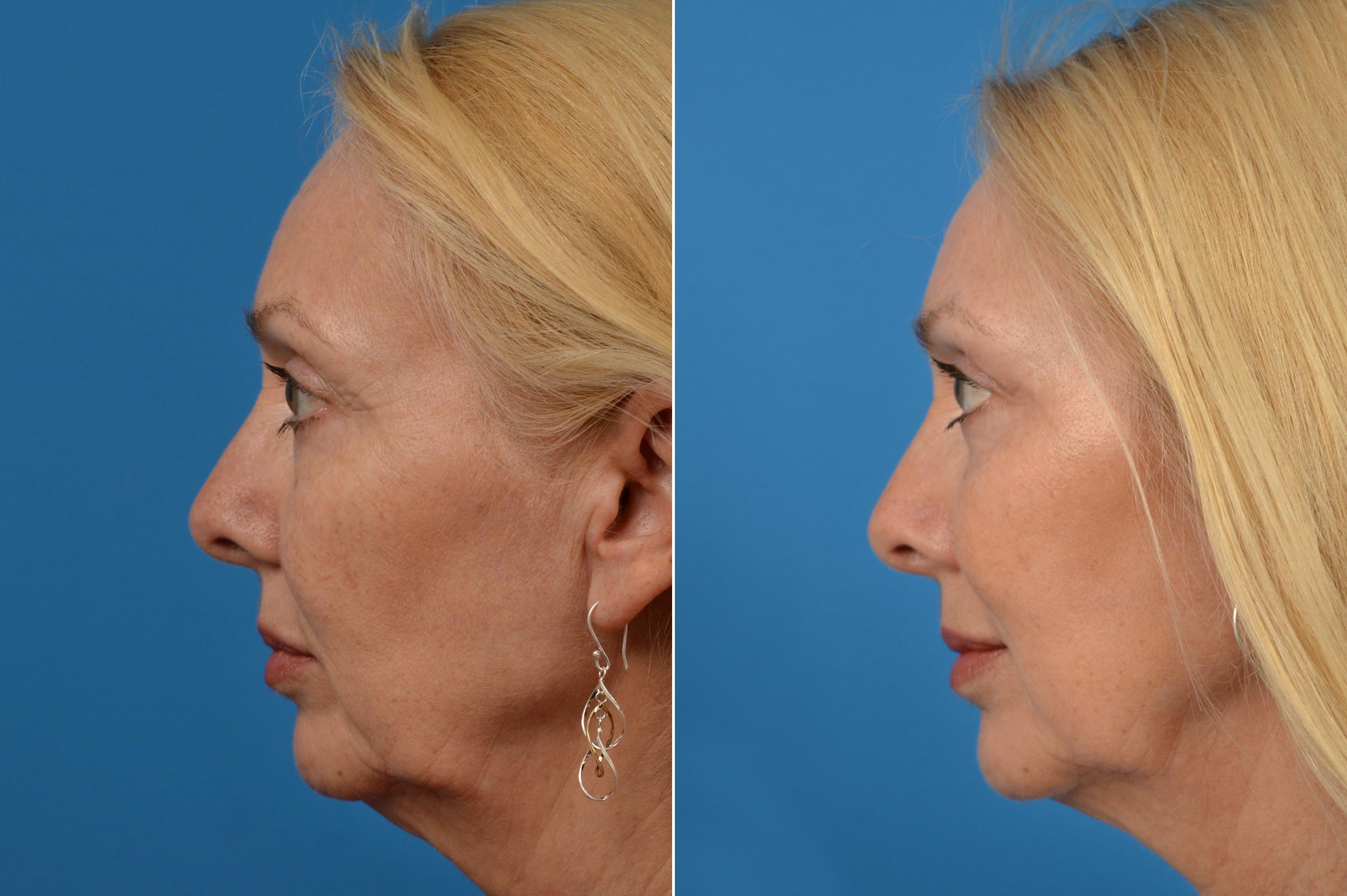 Eyelid Surgery Before & After Gallery - Patient 397326 - Image 3