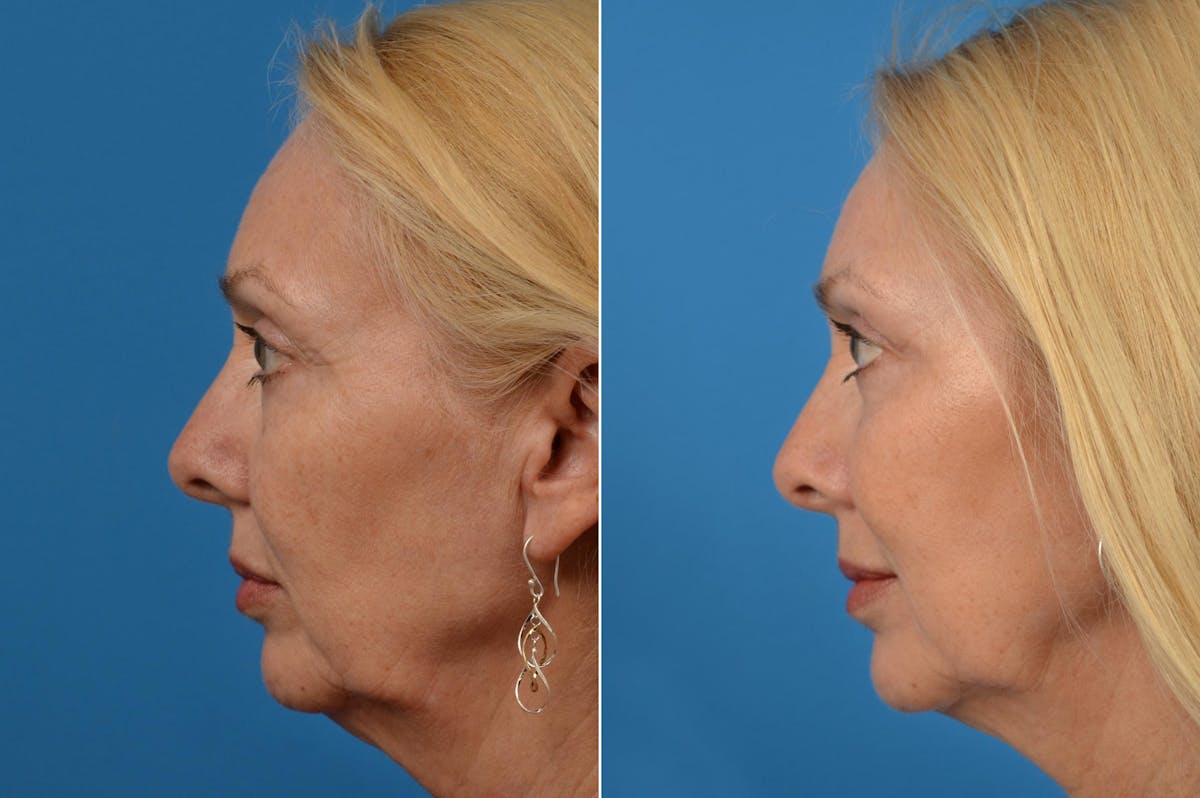 Eyelid Surgery Before & After Gallery - Patient 122444679 - Image 3