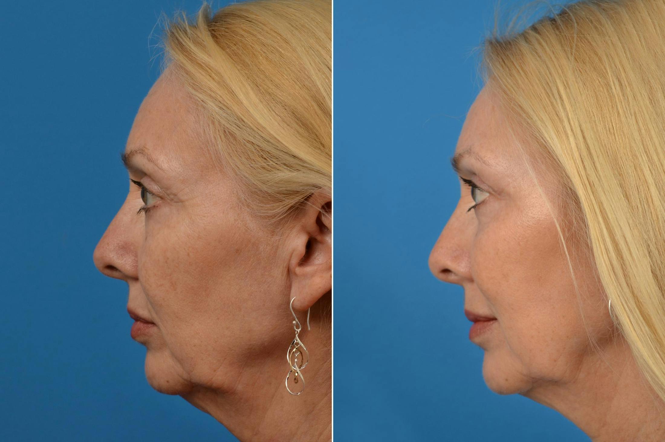 Eyelid Surgery Before & After Gallery - Patient 122444679 - Image 3