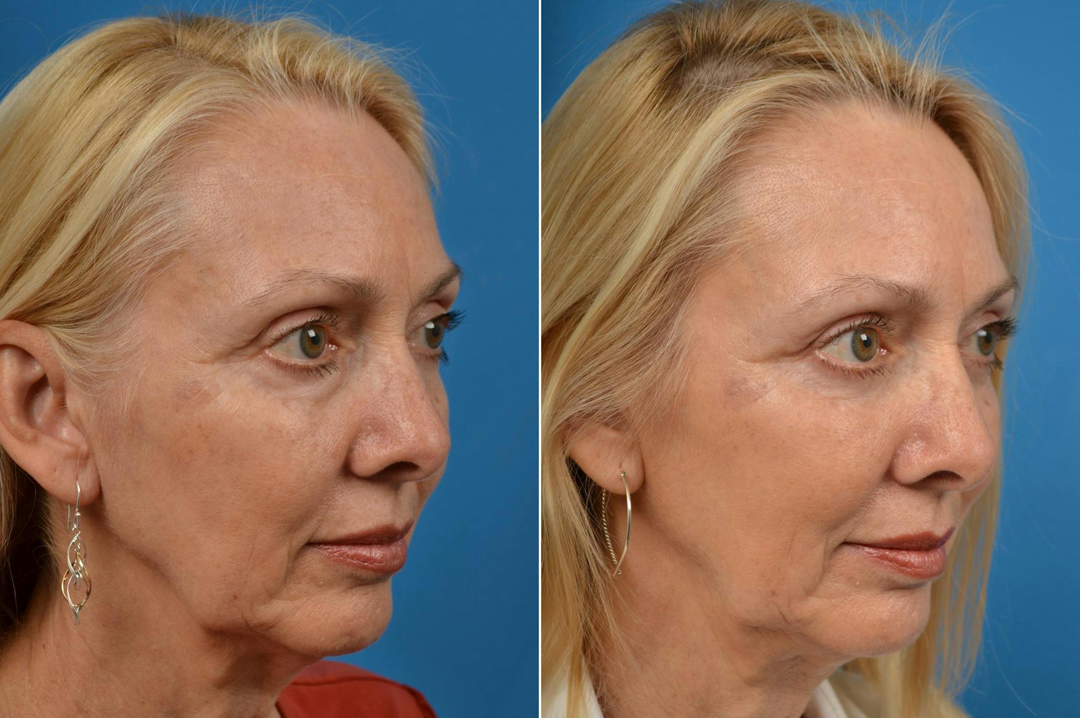 Eyelid Surgery Before & After Gallery - Patient 122444679 - Image 4