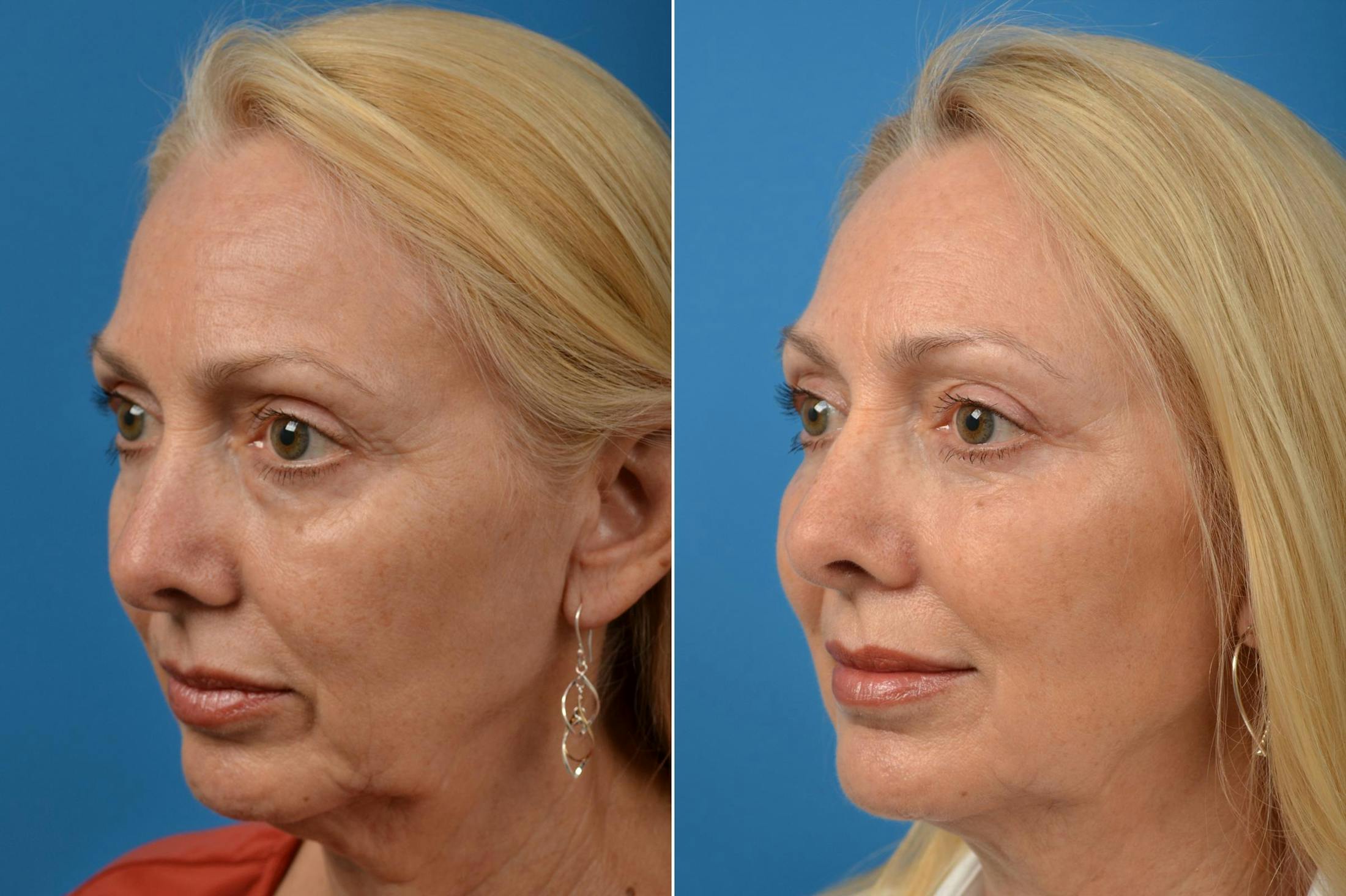 Eyelid Surgery Before & After Gallery - Patient 122444679 - Image 5