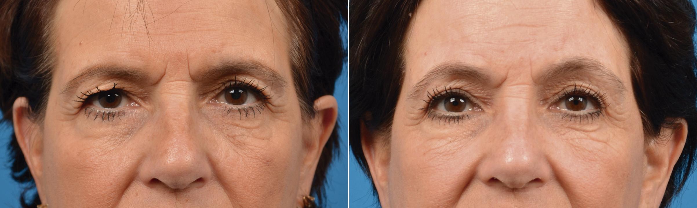 Eyelid Surgery Before & After Gallery - Patient 140140 - Image 1