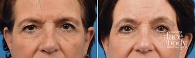 Eyelid Surgery Before & After Gallery - Patient 140140 - Image 1