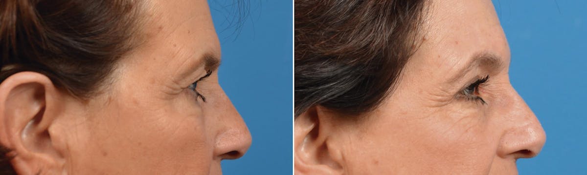 Eyelid Surgery Before & After Gallery - Patient 122444684 - Image 2