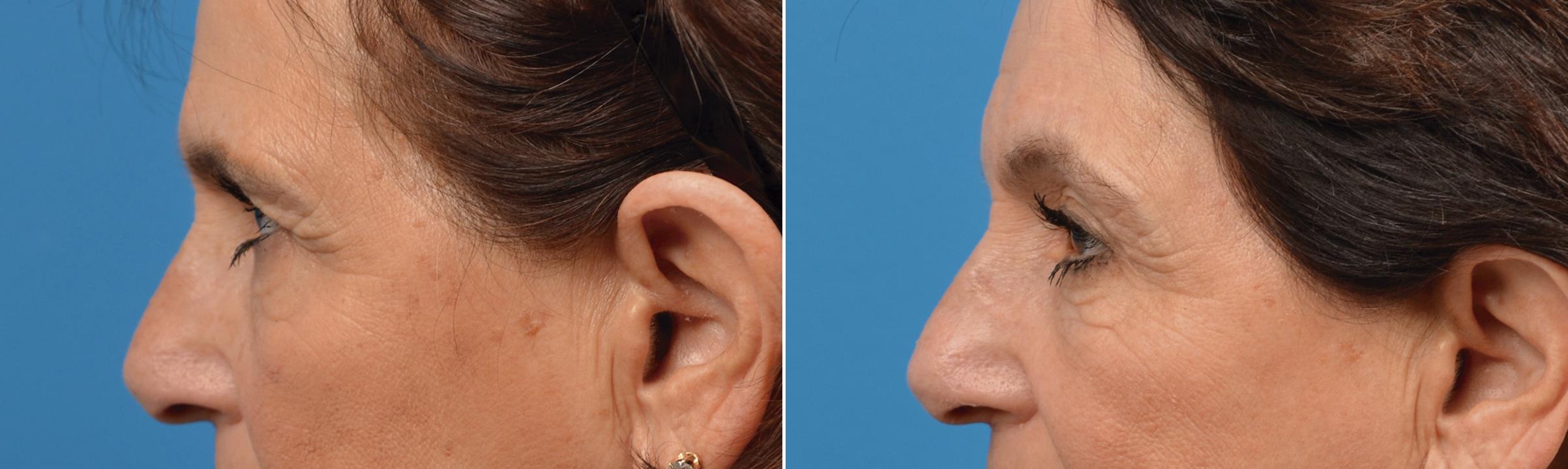 Eyelid Surgery Before & After Gallery - Patient 140140 - Image 3