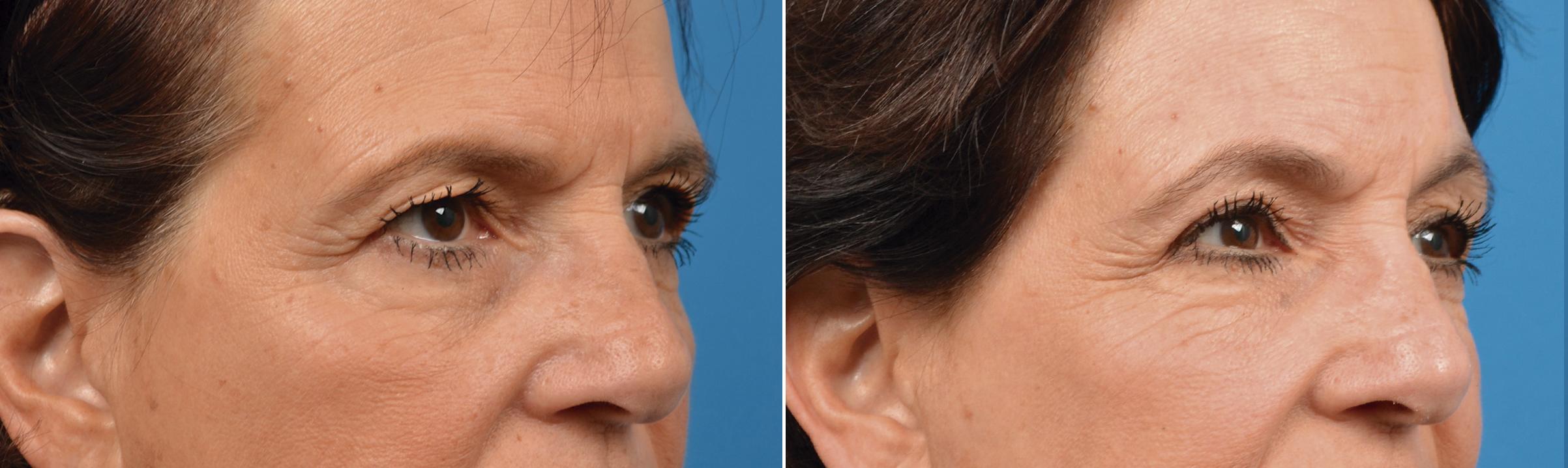 Eyelid Surgery Before & After Gallery - Patient 140140 - Image 4