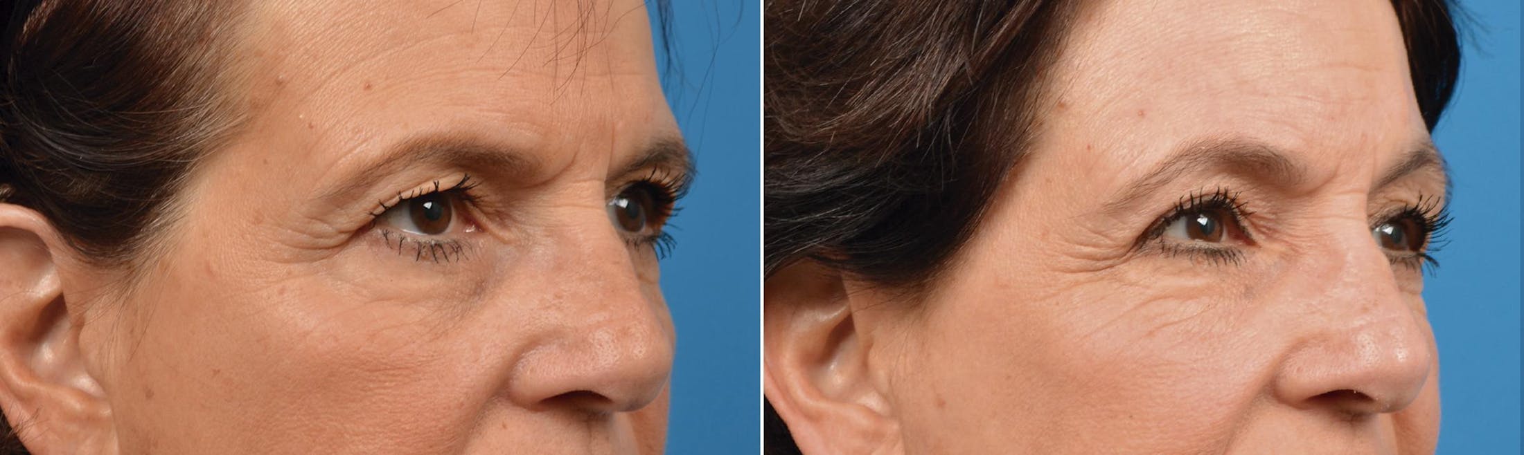 Eyelid Surgery Before & After Gallery - Patient 122444684 - Image 4