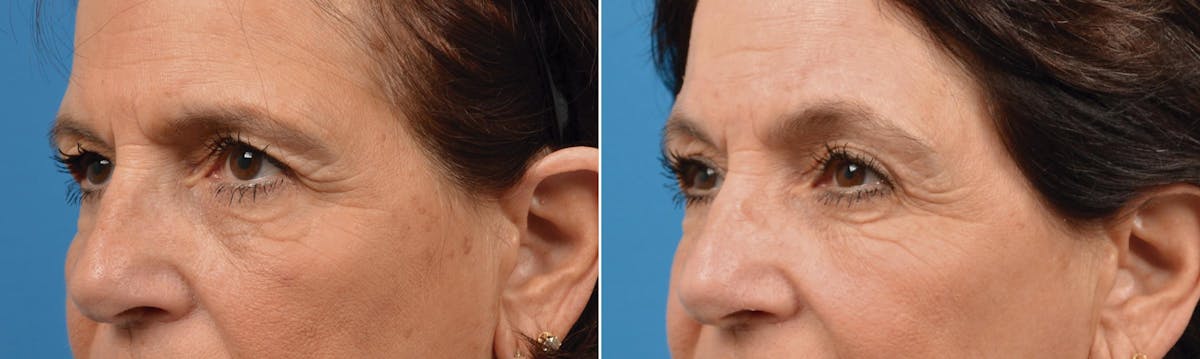 Eyelid Surgery Before & After Gallery - Patient 122444684 - Image 5