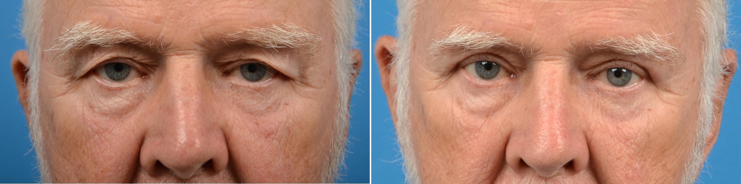 Eyelid Surgery Before & After Gallery - Patient 384677 - Image 1
