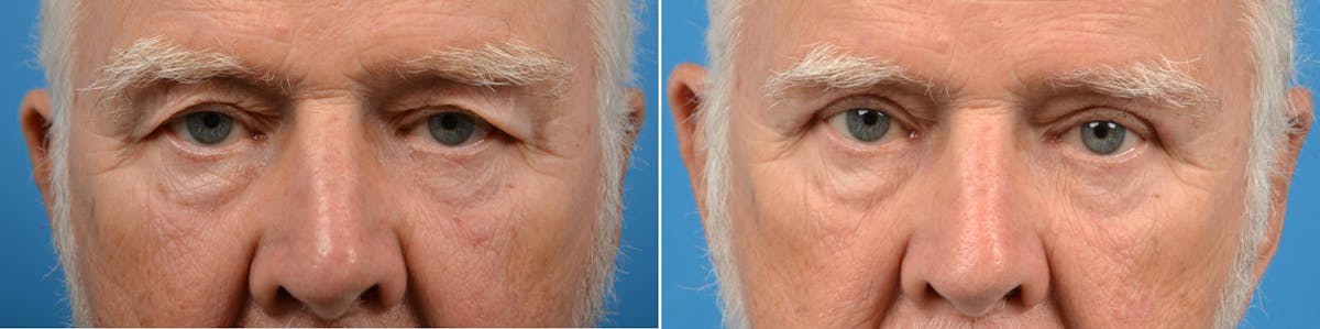 Eyelid Surgery Before & After Gallery - Patient 122444685 - Image 1