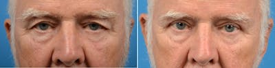 Eyelid Surgery Before & After Gallery - Patient 122444685 - Image 1