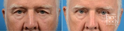 Eyelid Surgery Before & After Gallery - Patient 384677 - Image 1