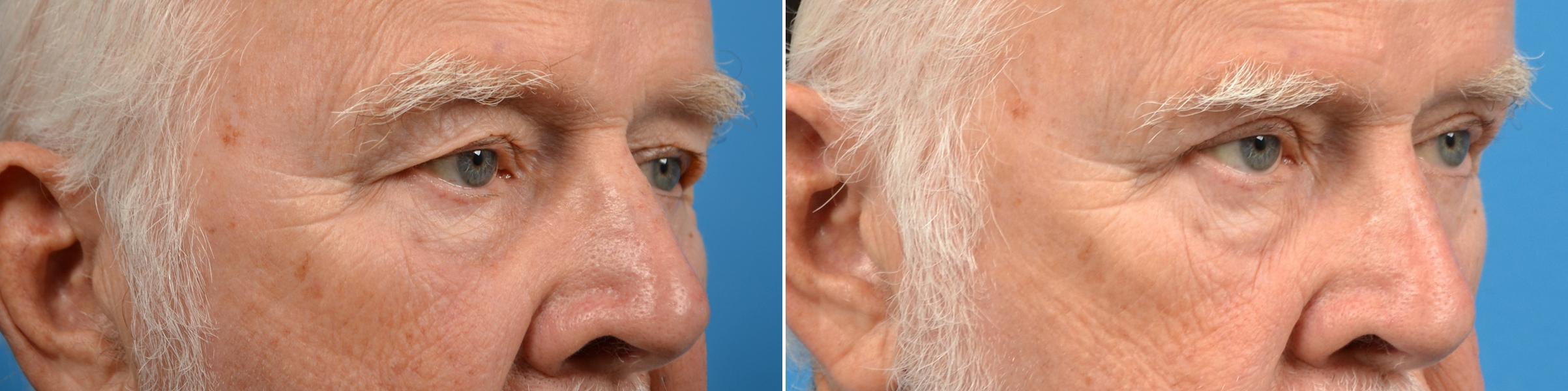 Eyelid Surgery Before & After Gallery - Patient 384677 - Image 2