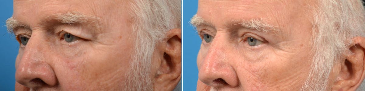 Eyelid Surgery Before & After Gallery - Patient 122444685 - Image 3