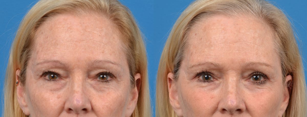 Eyelid Surgery Before & After Gallery - Patient 122444699 - Image 1