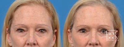 Eyelid Surgery Before & After Gallery - Patient 319733 - Image 1