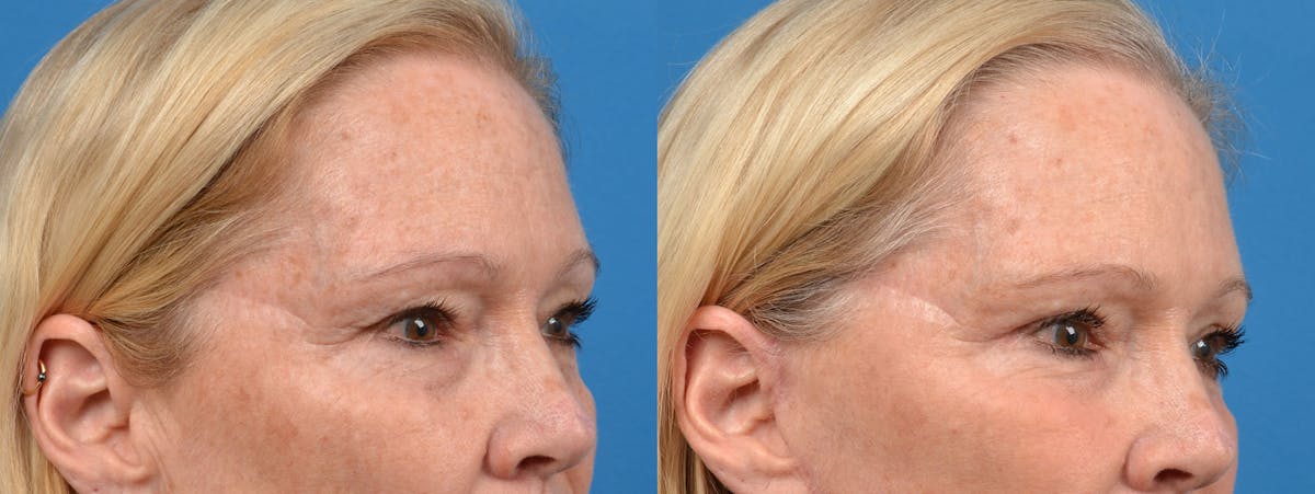 Eyelid Surgery Before & After Gallery - Patient 122444699 - Image 2