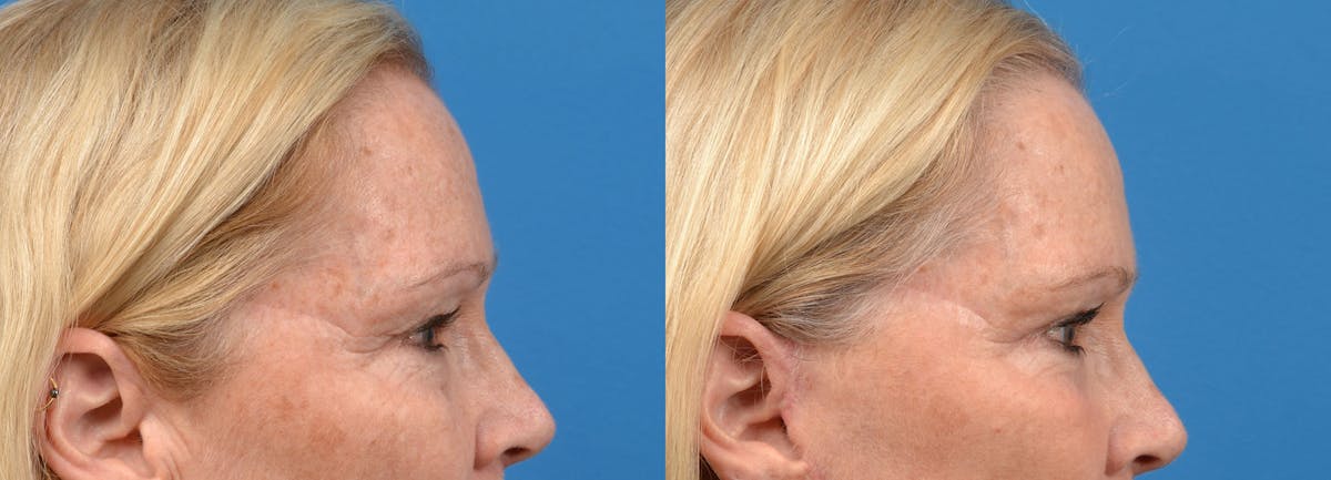 Eyelid Surgery Before & After Gallery - Patient 122444699 - Image 3