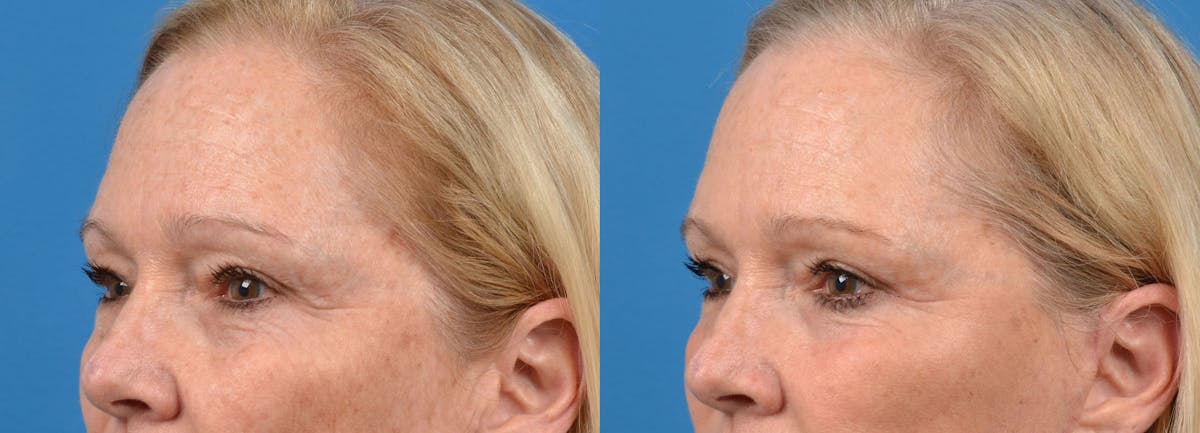 Eyelid Surgery Before & After Gallery - Patient 122444699 - Image 4