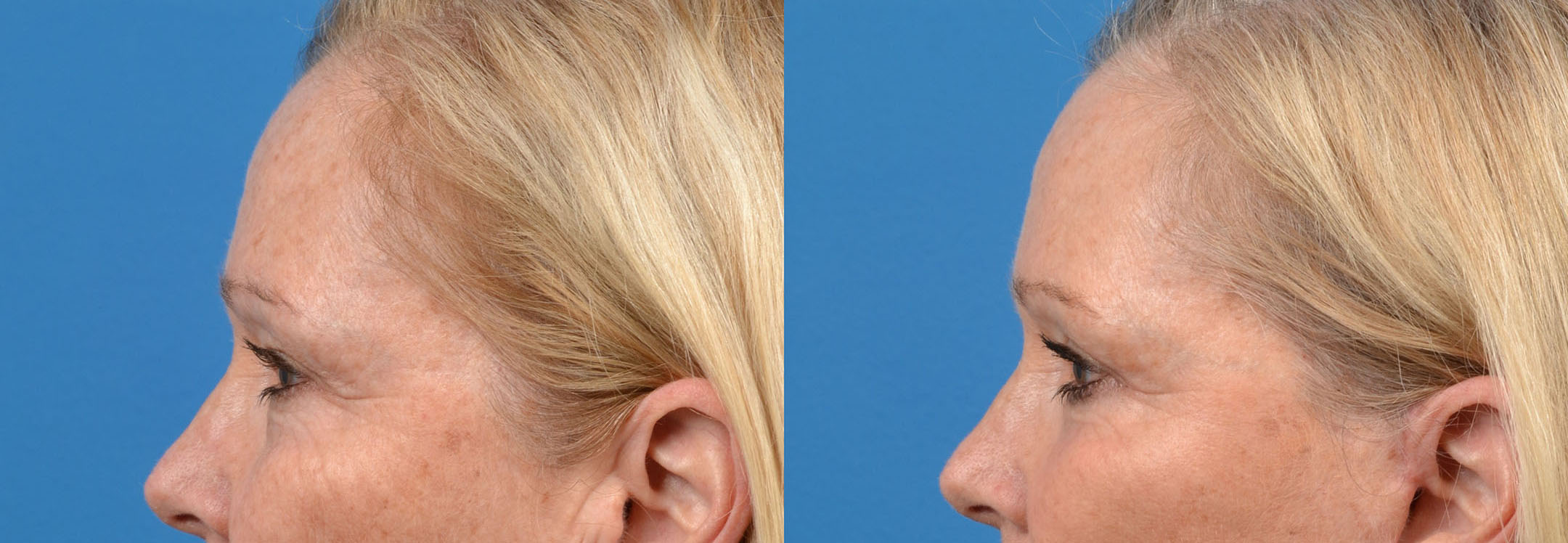 Eyelid Surgery Before & After Gallery - Patient 319733 - Image 5