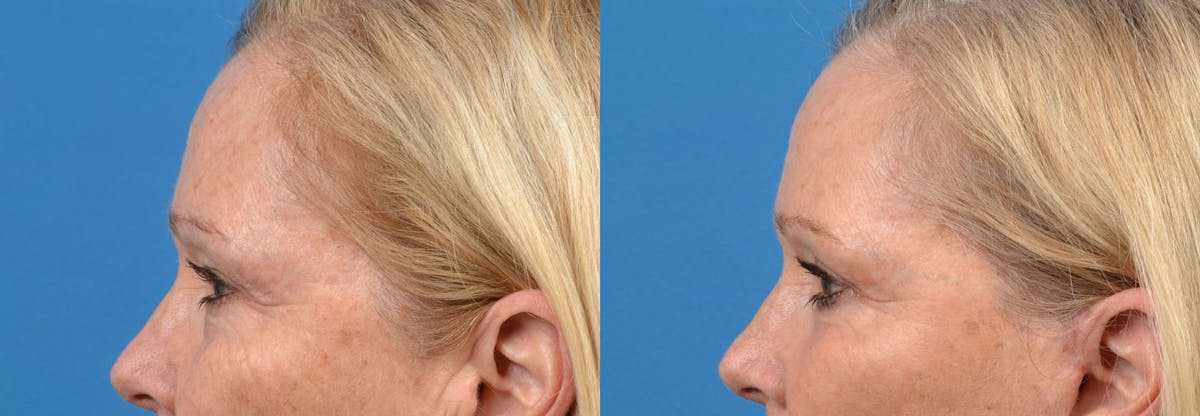 Eyelid Surgery Before & After Gallery - Patient 122444699 - Image 5