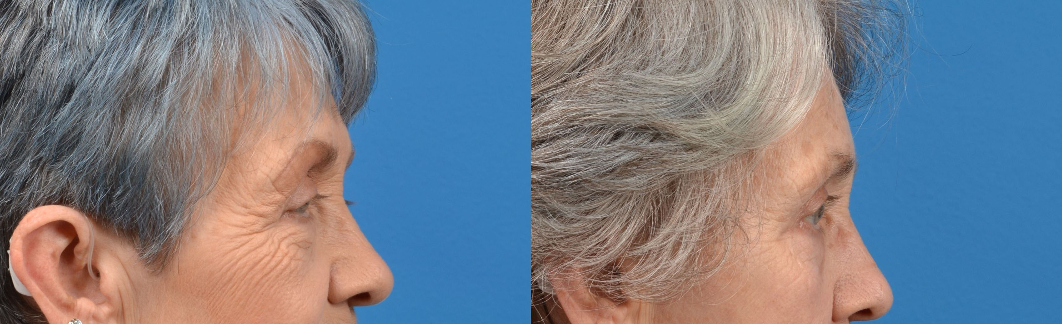 Eyelid Surgery Before & After Gallery - Patient 136712 - Image 1