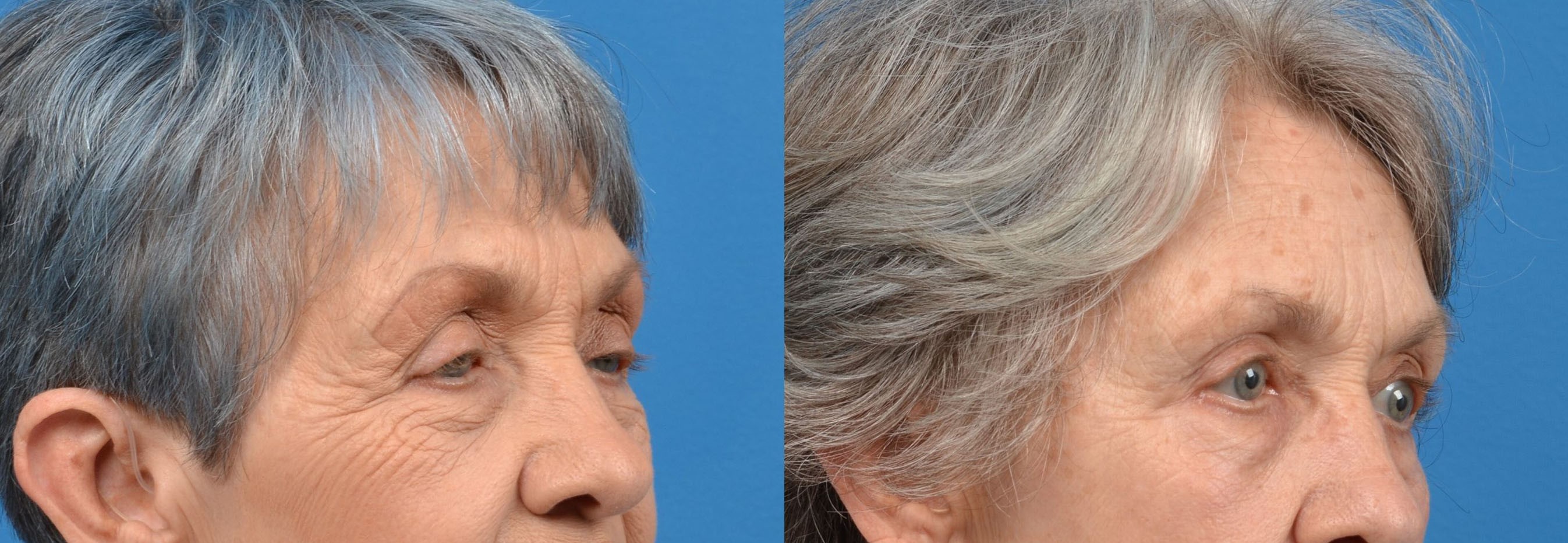 Eyelid Surgery Before & After Gallery - Patient 136712 - Image 2