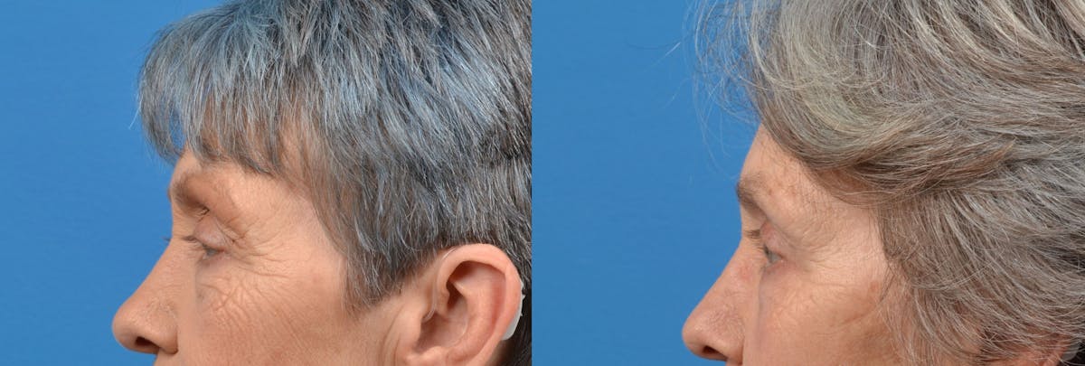 Eyelid Surgery Before & After Gallery - Patient 122444705 - Image 3