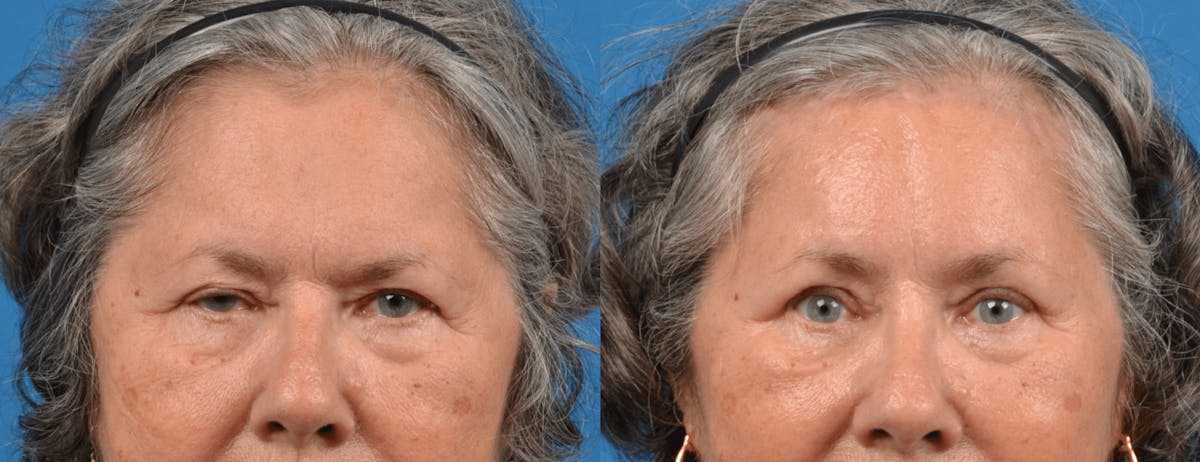 Eyelid Surgery Before & After Gallery - Patient 122444713 - Image 1