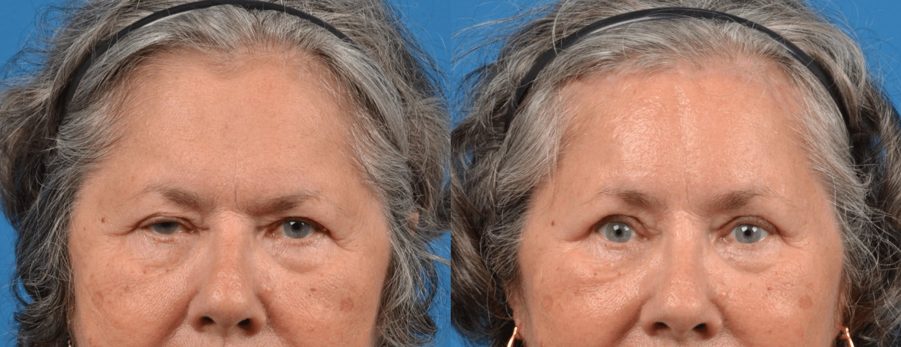 Eyelid Surgery Gallery - Patient 122444713 - Image 1