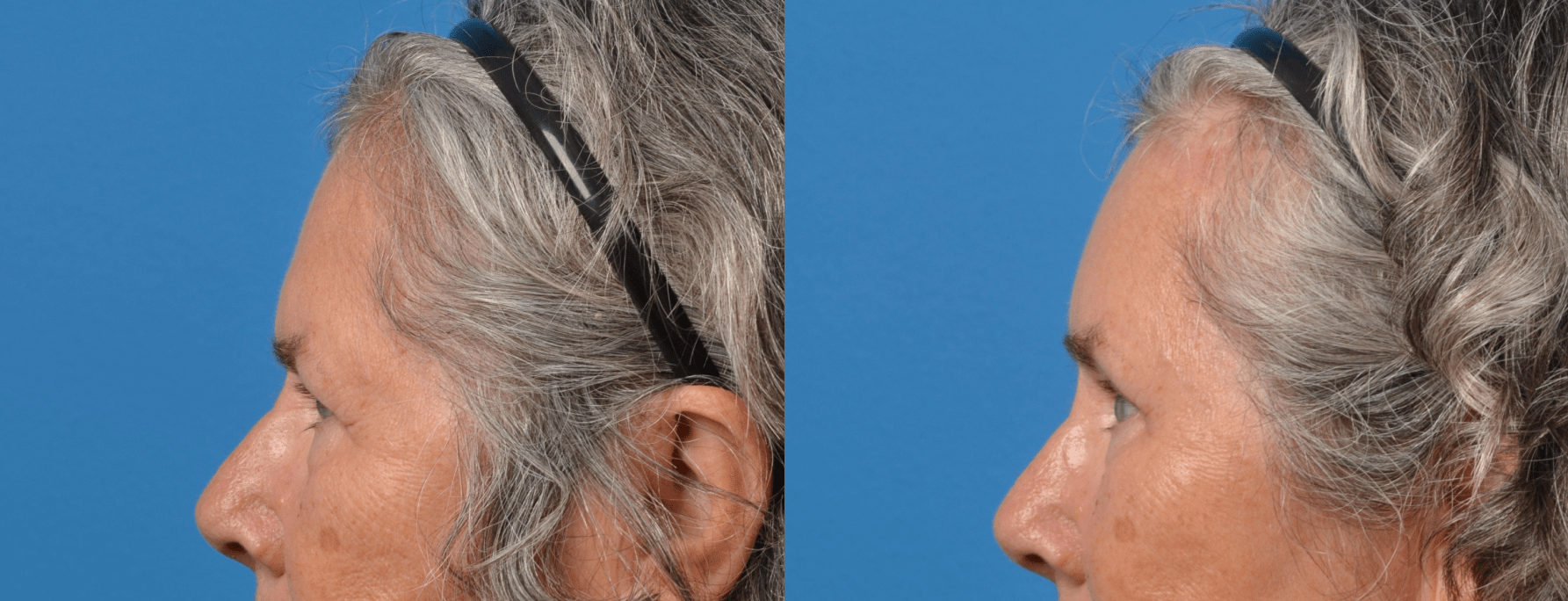 Eyelid Surgery Before & After Gallery - Patient 194669 - Image 2