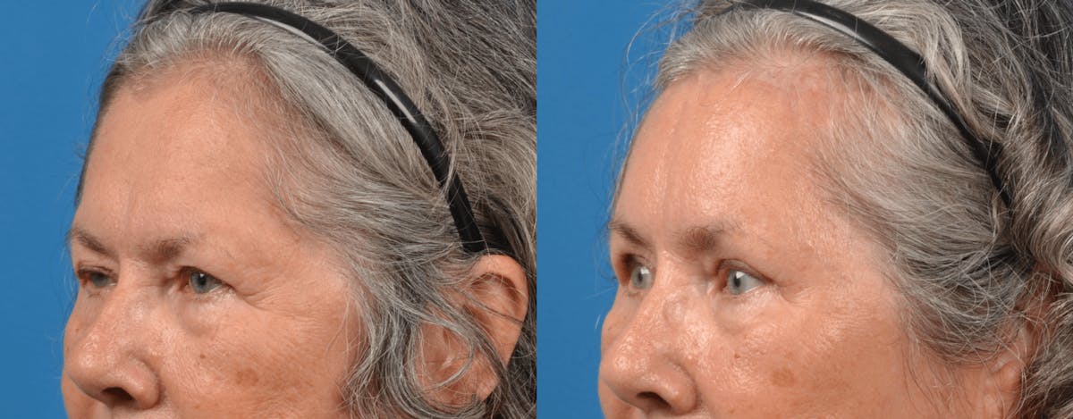 Eyelid Surgery Before & After Gallery - Patient 122444713 - Image 3