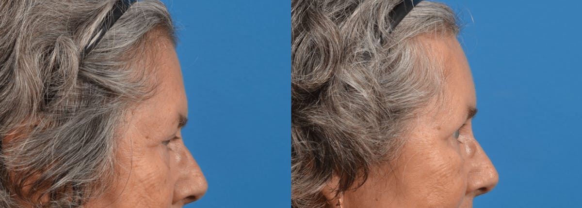 Eyelid Surgery Before & After Gallery - Patient 122444713 - Image 4