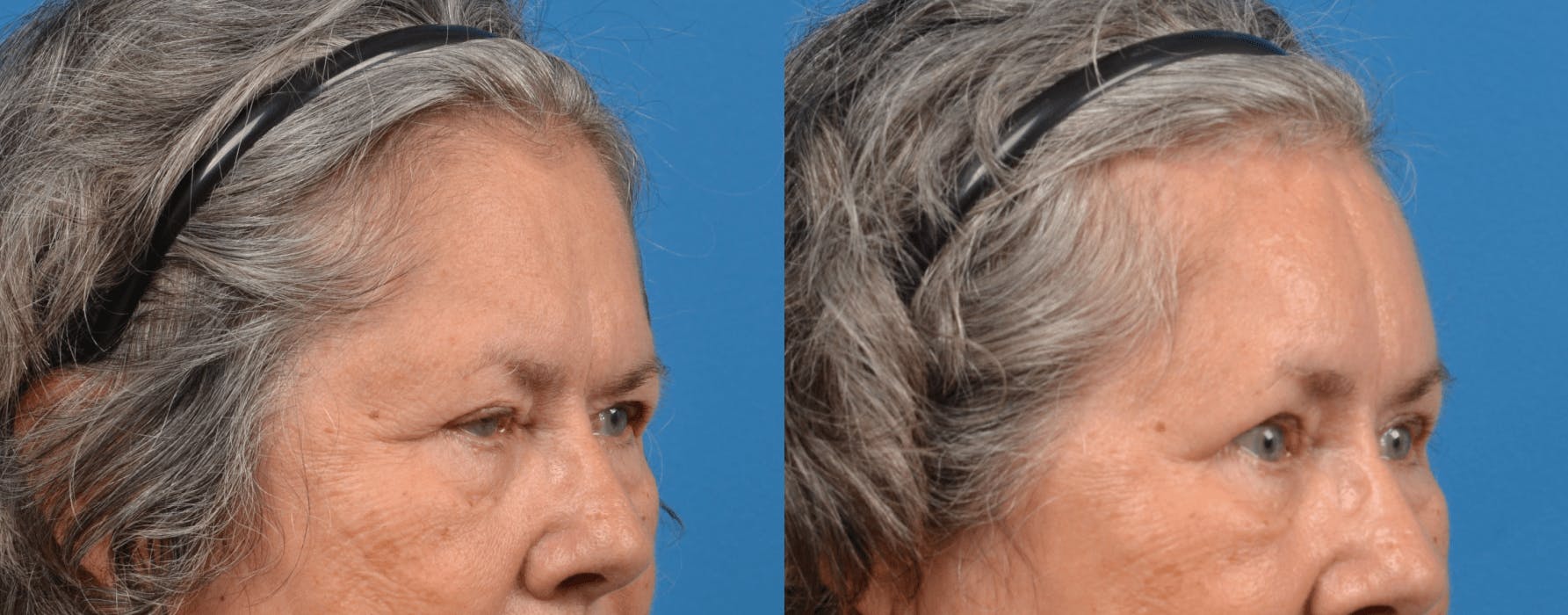 Eyelid Surgery Before & After Gallery - Patient 122444713 - Image 5