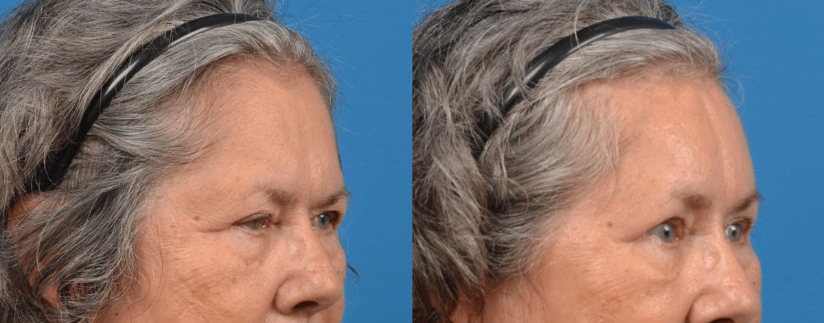 Eyelid Surgery Before & After Gallery - Patient 122444713 - Image 5