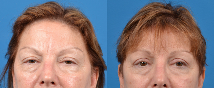 Eyelid Surgery Before & After Gallery - Patient 409021 - Image 1