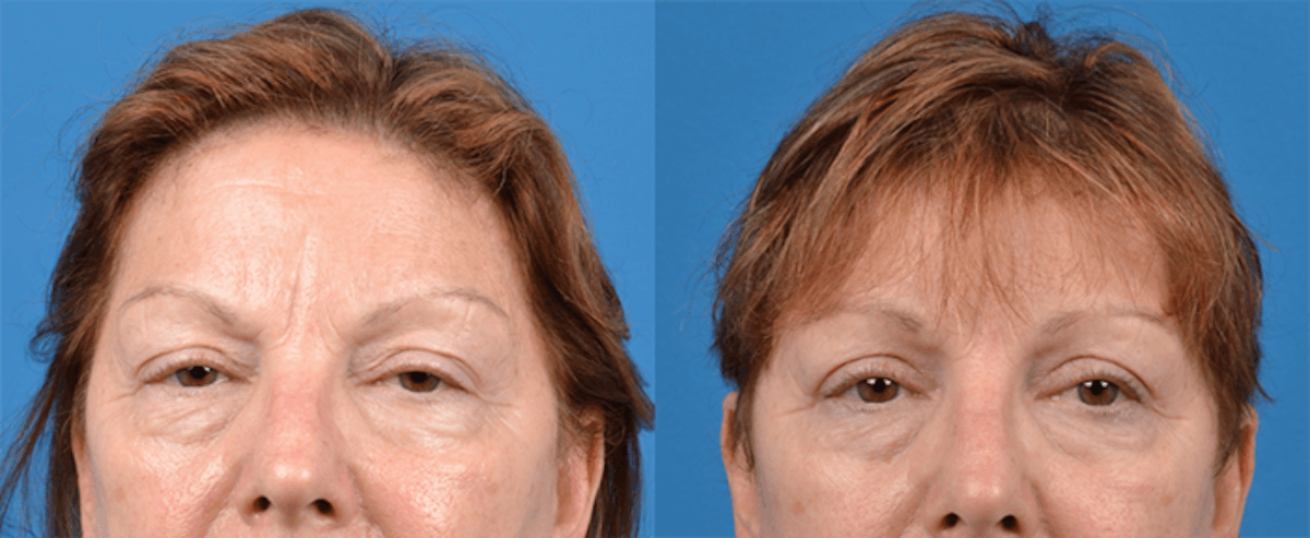 Eyelid Surgery Before & After Gallery - Patient 122444719 - Image 1