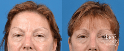 Eyelid Surgery Before & After Gallery - Patient 409021 - Image 1