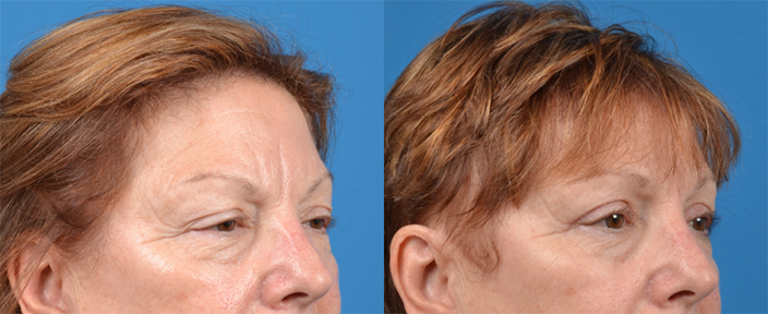 Eyelid Surgery Before & After Gallery - Patient 409021 - Image 2