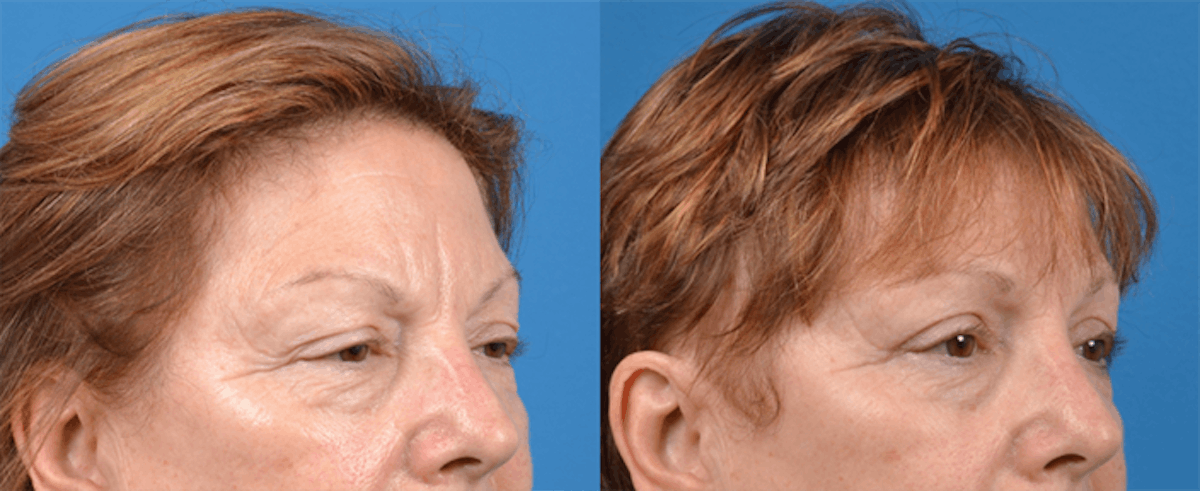 Eyelid Surgery Before & After Gallery - Patient 122444719 - Image 2