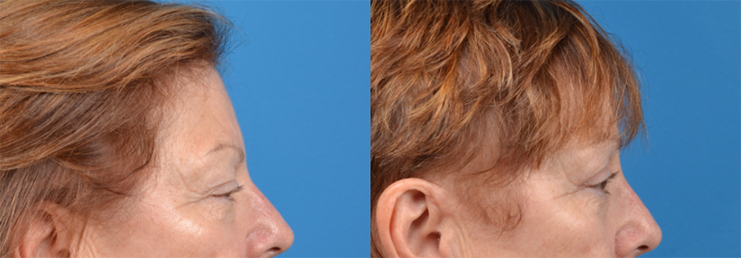 Eyelid Surgery Before & After Gallery - Patient 409021 - Image 3