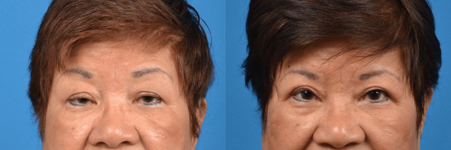 Eyelid Surgery Before & After Gallery - Patient 122444721 - Image 1