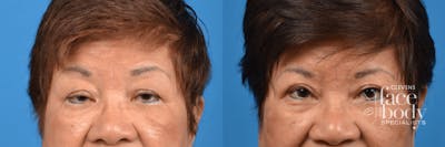 Eyelid Surgery Before & After Gallery - Patient 268062 - Image 1