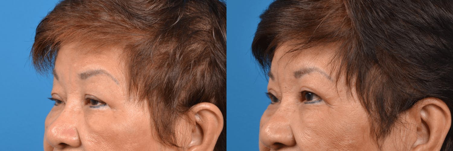Eyelid Surgery Before & After Gallery - Patient 122444721 - Image 2