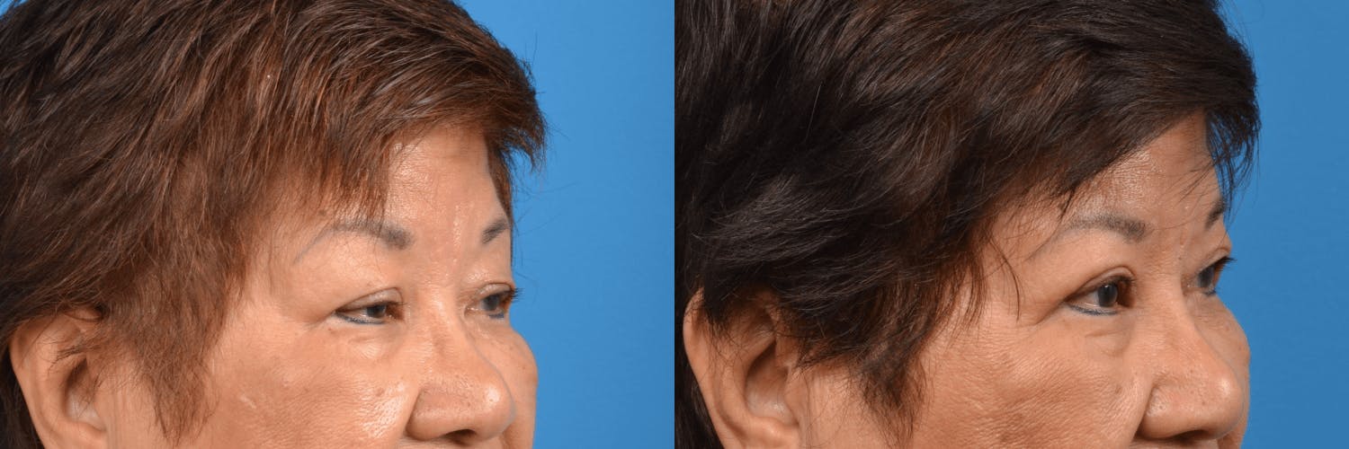 Eyelid Surgery Before & After Gallery - Patient 122444721 - Image 3