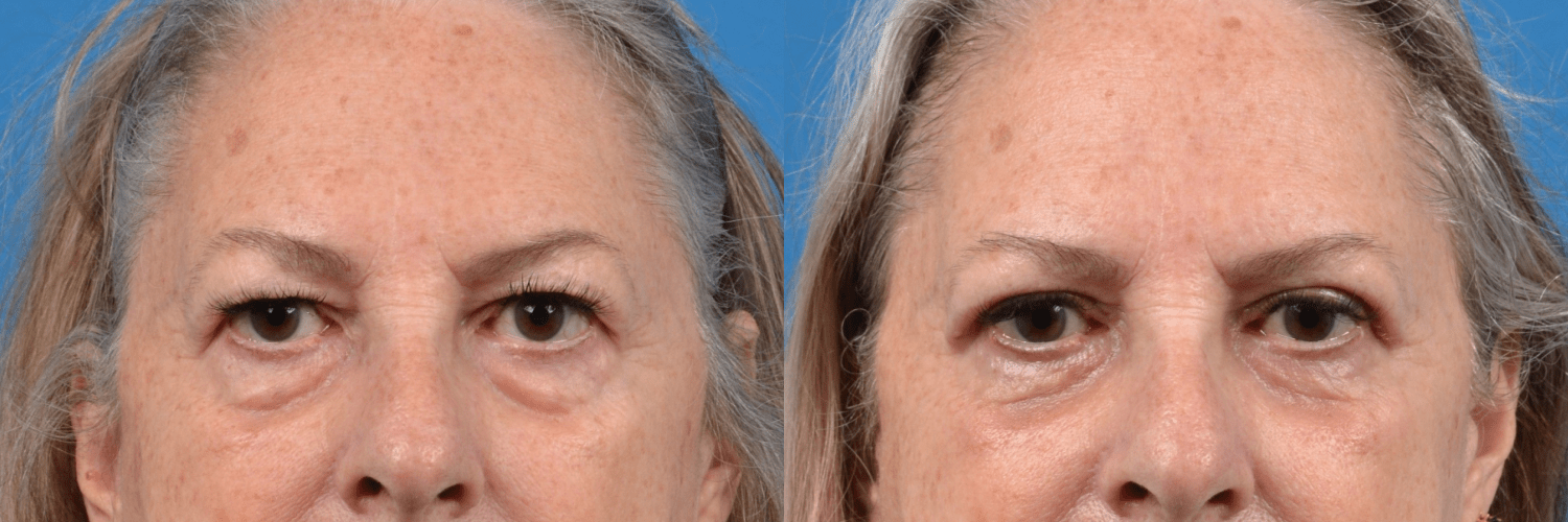 Eyelid Surgery Before & After Gallery - Patient 125858 - Image 1