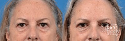 Eyelid Surgery Before & After Gallery - Patient 125858 - Image 1
